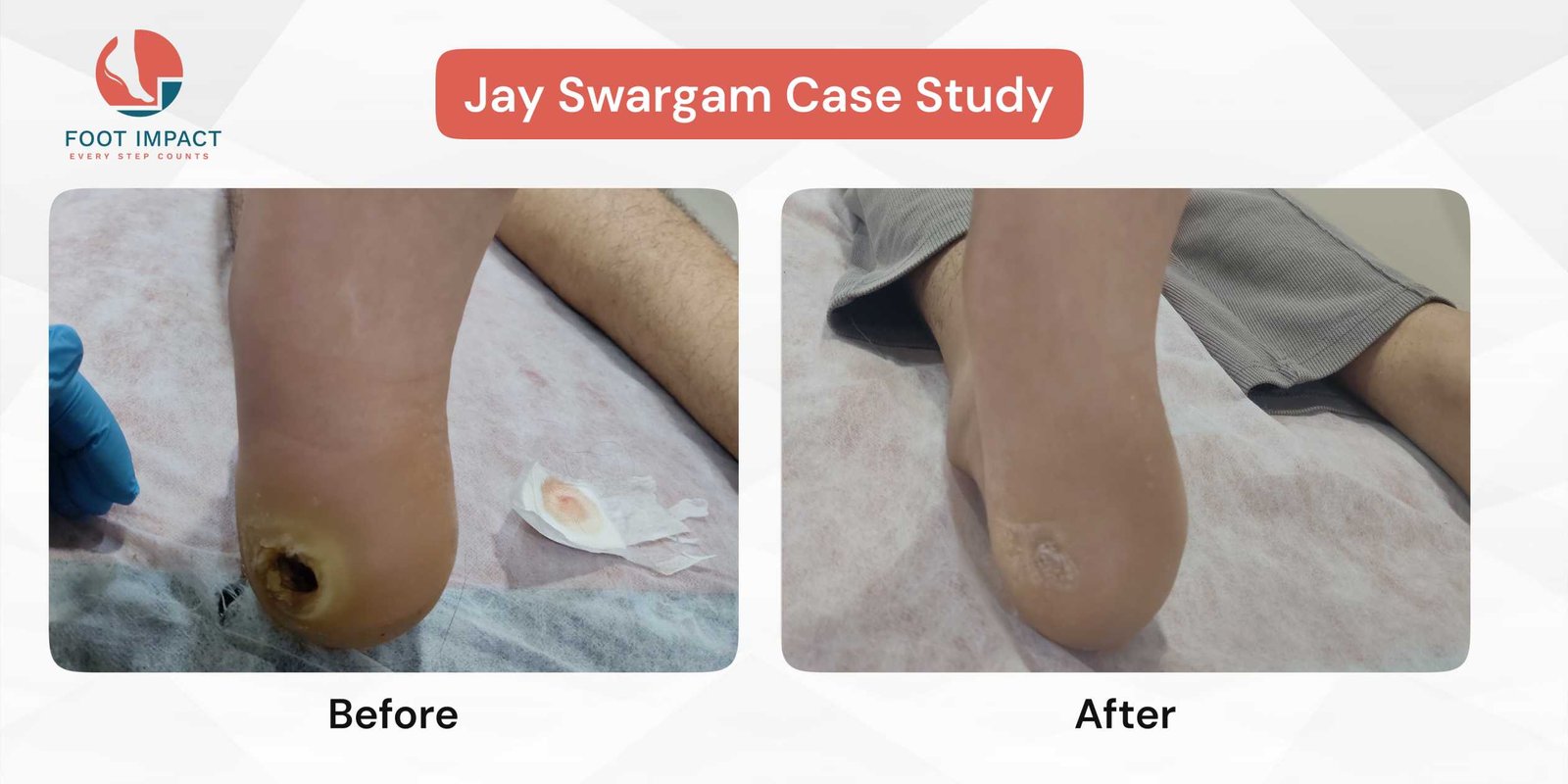 A Step Toward Healing: Beating a Trophic Ulcer with Custom Footwear