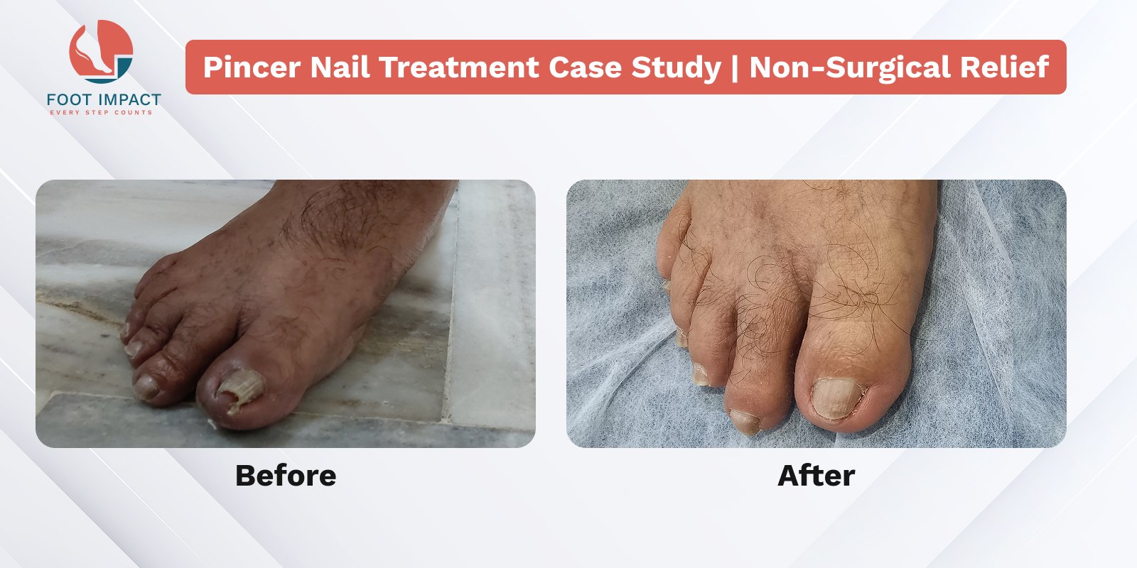 Pincer Nail Treatment Case Study | Non-Surgical Relief